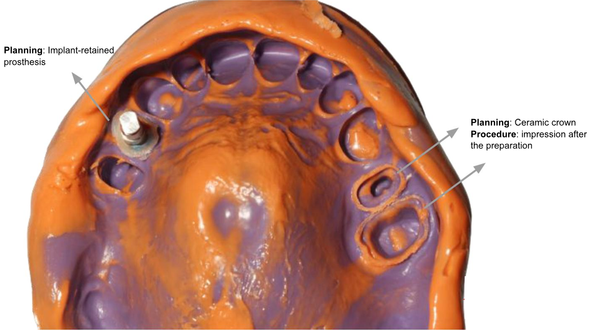 CLINICAL CASES:PERFIT IMPRESSION MATERIALS 2