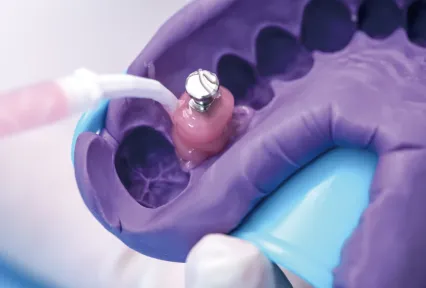 GumEasy™A - Silicone para máscara gengival: onde a precisão encontra a estética em restaurações de implantes