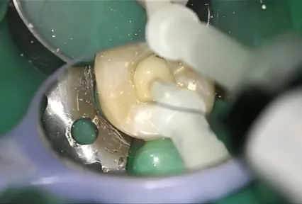 Reconstrução Confiável de Núcleo Posterior com UltraCore: Caso Clínico no Dente #37