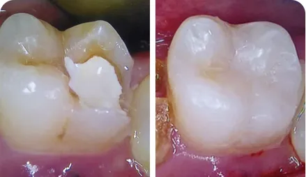 Restauração Direta de Compósito Classe II do Dente #36 Tratado Endodonticamente