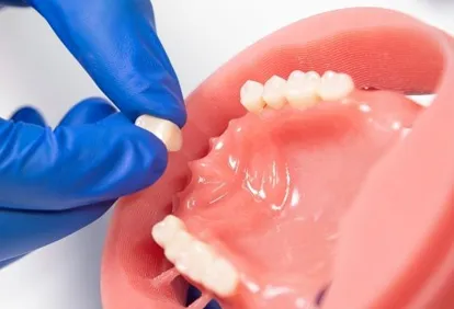 custo do material de implante dentário